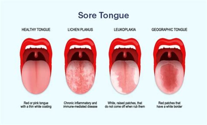 Why is my tongue patchy and white?